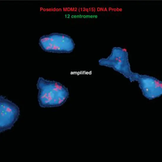 MDM2 (12q15) Gene Amplification by FISH